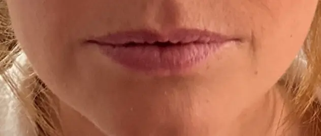 Before lip filler treatment for dry, thinning lips