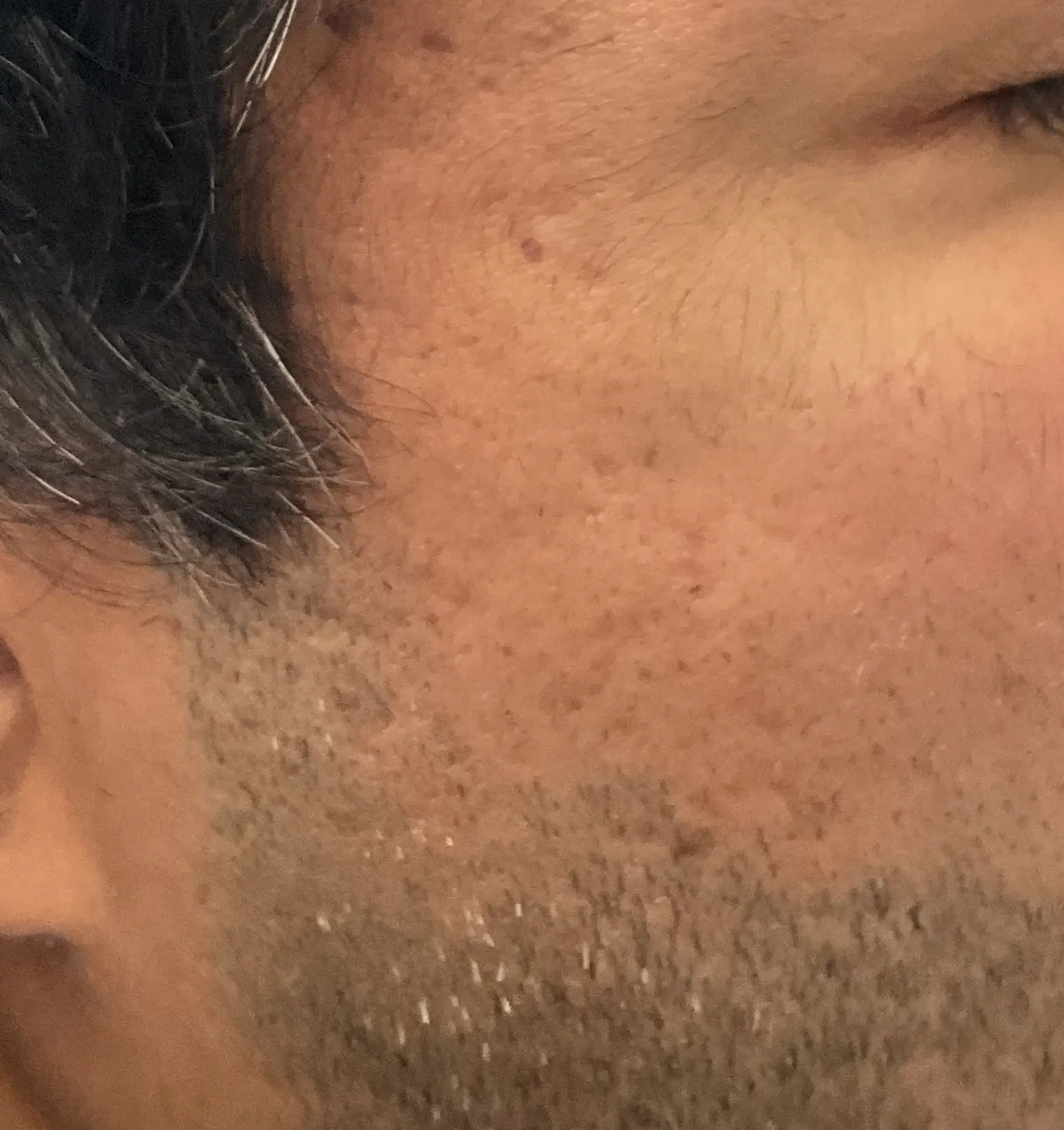 After PRP treatment for acne scarring and uneven skin texture