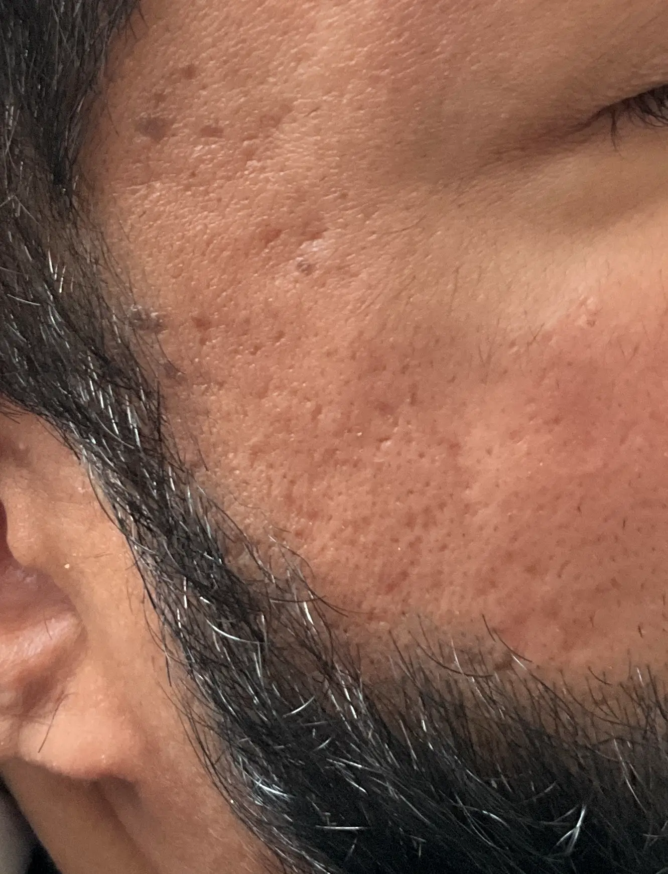 Before PRP treatment for acne scarring and uneven skin texture