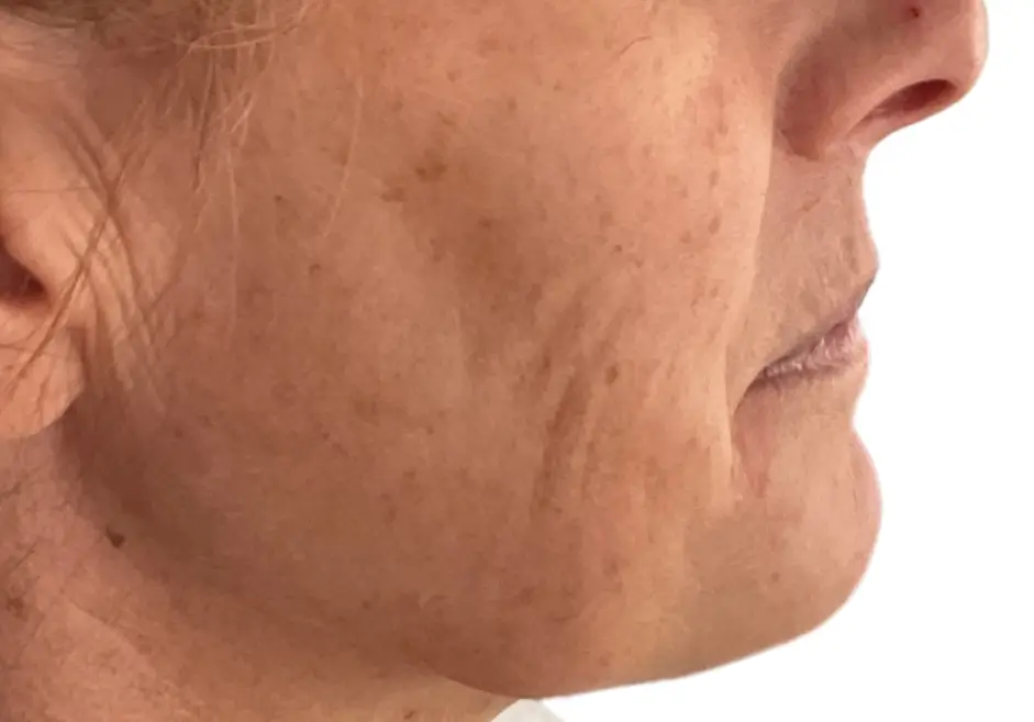 After PRP treatment for acne scarring and uneven skin texture