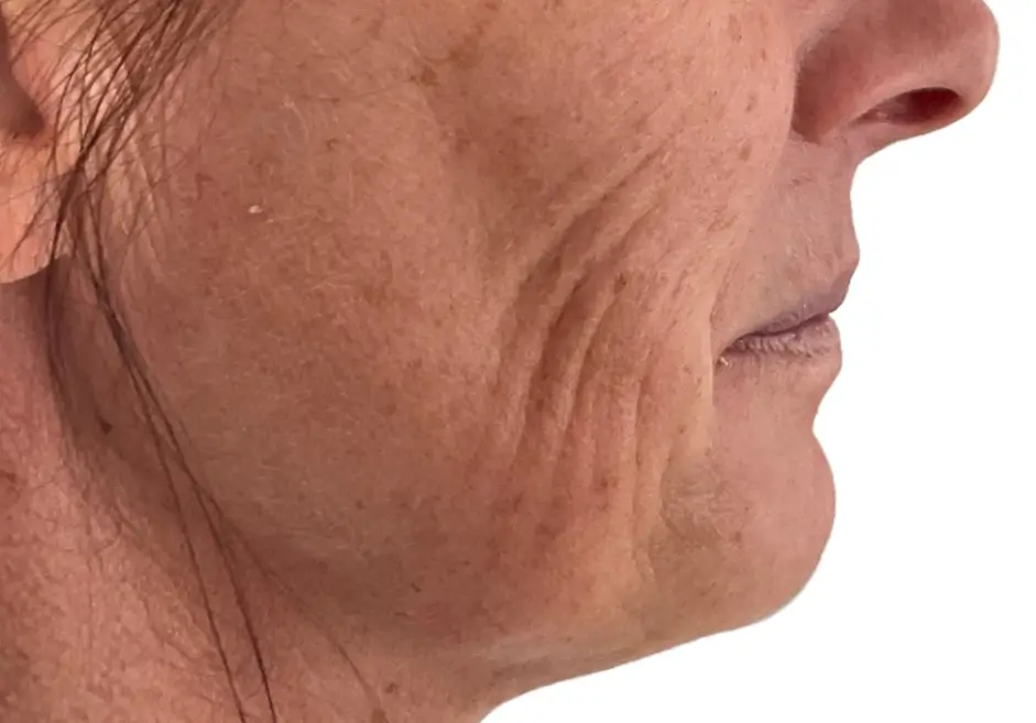 Before PRP treatment for acne scarring and uneven skin texture