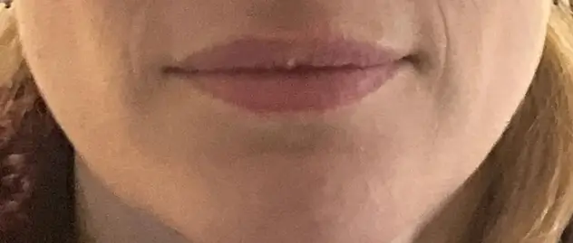 After dermal filler treatment for smile lines and jowls