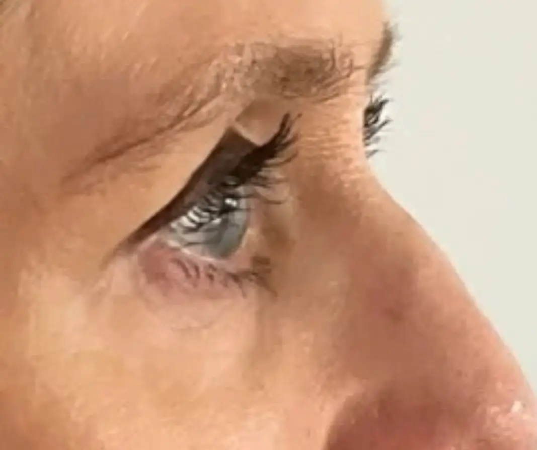 After tear trough filler treatment for under-eye hollowing